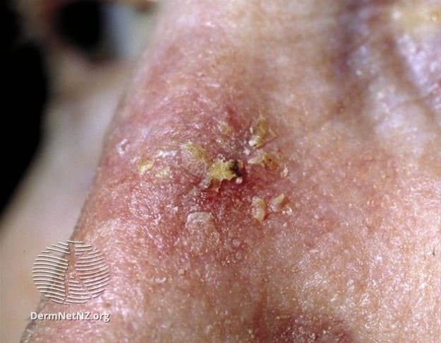 actinic keratosis nose